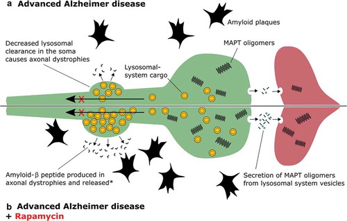 Figure 1. Treatment of advanced AD with rapamycin. (A) In Alzheimer disease, lysosomal-system cargo (yellow vesicles) that should be retrogradely transported up an axon (green) to the soma, where lysosomal degradation occurs, accumulate because lysosomal function is critically damaged. (B) Treatment with rapamycin enhances the generation of lysosomal-system cargo, and during AD this will result in further accumulation of lysosomal vesicles. According to the literature this may promote propagation of MAPT aggregates to another neuron (red), and further production of amyloid plaques. *How release of amyloid-β from the dystrophy occurs is poorly understood but could happen by fusion of lysosomal-system cargo with the axon’s plasma membrane, or rupture of this membrane and release of lysosomal-system contents into the parenchyma.