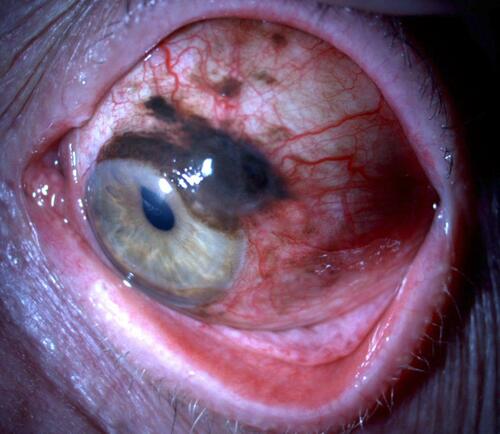 Figure 1 Conjunctival melanoma arising from a pre-existing PAM lesion.