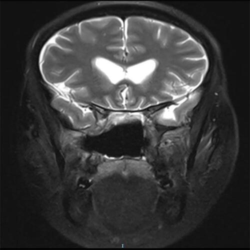 Figure 3 Magnetic resonance imaging revealing a significant decrease in bilateral ventricular pneumocephalus.