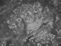 Figure 2. Immunofluorescent staining of kidney biopsy tissue showing mesangial deposits of IgA.