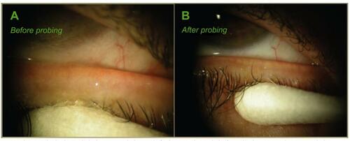 Figure 9 Case study of probing of lower lid for patient in Figure 8: (A) before probing, the left lower lid had 0 expressible glands and VAS of 47 of 100 tenderness for diagnosis of CDO, while 1 week after probing (LL After); (B) the same lid had more than 10 expressible glands and VAS showed 0 of 100 tenderness for a diagnosis of PDO. Reproduced with permission from Maskin SL. Intraductal meibomian gland probing: a paradigm shift for the successful treatment of obstructive meibomian gland dysfunction. In: Tsubota K, ed. Diagnosis and treatment of meibomian gland dysfunction. Tokyo, Japan: Kanehara & Co., Ltd; 2016:149–167.Citation7