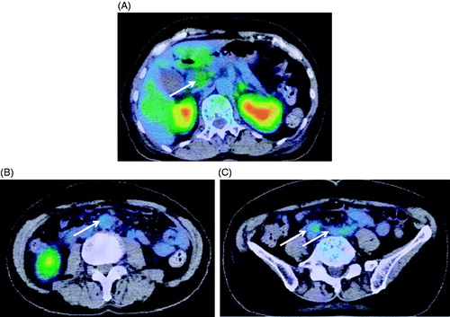 Figure 3. Fluorine-18-fluorodeoxyglucose positron emission tomography (FDG-PET) at day 30. (A) Abnormal uptake of FDG in the pancreas head; (B) Abnormal uptake of FDG in fat tissue around the aorta; (C) Abnormal uptake of FDG in the peritoneum.