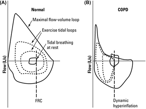 Figure 5 Flow volume loops at rest and exercise. Tidal flow volume loops relative to maximal at rest (solid lines) and exercise (dashed lines) for a healthy individual (Normal, A) and an individual with obstructive lung disease (COPD, B). For Normal, tidal volume expands during exercise by both increase in end inspiratory volume and decrease in end expiratory volume. In COPD, the flow volume tracing of spontaneous breaths moves to the left as end expiratory volume increases due to dynamic hyperinflation. FRC, functional residual capacity. Reprinted with permission from Al Talag A, Wilcox P. Clinical physiology of chronic obstructive pulmonary disease. BCMJ. 2008;50(2):97–102.Citation8