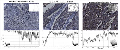 Figure 4. IL-10 and TGF-β expression within metastatic adenocarcinomas. Each tissue is displayed with the gray scale image, with an applied threshold, in the top right corner of the image. Below each image is the intensity map of the tissue with the gray values on the Y-axis. Within each of the intensity maps is a graphical representation of the level of gray staining. The scale bar indicates a magnification of 200. (A) Tissue from a 43-year-old male with grade 2 metastatic adenocarcinoma from the colon had minimal levels of IL-10 expression representative of 44% of patients. (B) Tissue from a 51-year-old female with metastatic adenocarcinoma who had significantly upregulated expression of IL-10 representative of 55% of tissue evaluated. (C) Tissue from a 58-year-old male with metastatic adenocarcinoma stained with TGF-β. All metastatic tissues exhibited this same level of TGF-β staining. This level of staining was consistent through all of the tissue types.