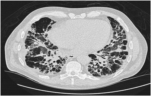 Figure 1. HRCT with severe interstitial findings with peribronchial infiltrates and ground-glass opacities (GGO) in all lung fields, especially in the upper lobes. There was mediastinal lymphadenopathy