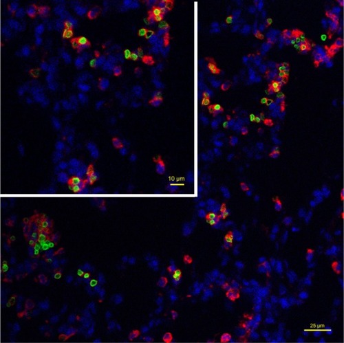 Figure 10 Intracellular localization of fluorescent SPION microbubbles inside labeled macrophages. A primary antibody against CD68 (red) confirms phagocytosis of the microbubbles (green) by macrophages in the lungs. The nuclei were stained blue using DAPI. The size bar represents 25 μm. The upper left part of the image is higher magnification with the size bar of 10 μm.Abbreviations: DAPI, 4′,6-diamidino-2-phenylindole; SPION, superparamagnetic iron oxide.