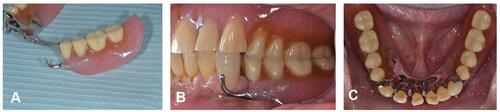 Figure 10 (A) Denture photographs and (B and C) intraoral after treatment. Retrofitted zirconia crown and I-bar clasp under the existing RPD.