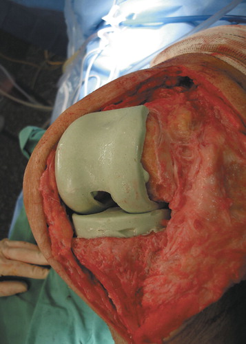 Figure 3. Implantation of the intraoperative molded PMMA knee spacer.