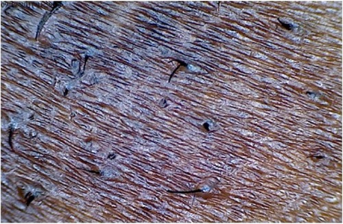 Figure 5 Multiple sharp, beveled hair tips after a dry shave.