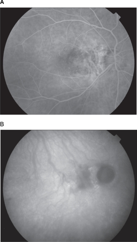 Figure 4 Six months after PDT late-phase FA A) and ICG B) show absence of leakage and complete disappearance of the CNV.