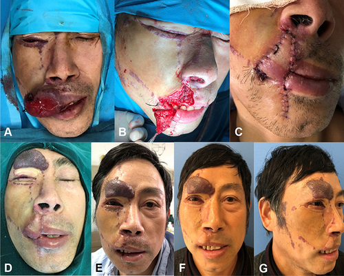Figure 2 Case 2. A 55-year-old male had hypertrophic PWS in the right upper lip which was accompanied by ulceration and infection. The lesions were completely removed, and an abbé flap was used to repair the wound in the first-stage operation. The flap survived well. Two weeks later, secondary procedure was performed to divide the pedicle. (A) The preoperative view. (B) The intraoperative view. (C) One week after the first-stage operation. (D) The flap survived well and was ready to undergo the pedicle division surgery. (E) The flap pedicle was successfully divided. (F–G) Postoperative views three months later. Evaluation result was “very satisfied (score of 5)”.