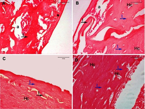 Figure 7 H&E stained at 8 weeks post-surgery, 20× magnification; fracture site at the level of bone–implant interface: (A) Control group: incomplete newly formed spongy bone trabeculae (t-black arrow) delimiting areole (a) with bone marrow, and fibro-cartilaginous callus (*), clotted blood formed by inflammation, exudation and residual chondrocytes, partially still present at the fracture level; (B) PESW group: fibro-cartilaginous callus is completely resorbed, and a mixture of spongy bone, well-defined trabeculae (t-black arrow) delimiting areole (a), and compact bone (lamellar bone (l-blue arrows) around Haversian canals (Hc)); (C) HAPc group: there are less spongy bone trabeculae (t-black arrow), mainly areas of compact lamellar bone deposition (l-blue arrow), and Haversian canals (Hc) with a slightly irregular disposition of bone lamellae around them; (D) HAPc+PESW group: newly formed bone is compact lamellar bone (l) with regular, concentric disposition of bone lamellae (l-blue arrows) around Haversian canals (Hc), without areas of spongy bone trabeculae, indicating the more advanced stage of bone remodeling and the most complete bone fracture healing at this phase.  Abbreviations: H&E = hematoxylin and eosin; CG = control group; PESW = pulsed electromagnetic short-waves; HAPc = titanium implants coated with multisubstituted hydroxyapatite and collagen; HAPc+PESW = titanium implants coated with multisubstituted hydroxyapatite and collagen and pulsed electromagnetic short-waves.