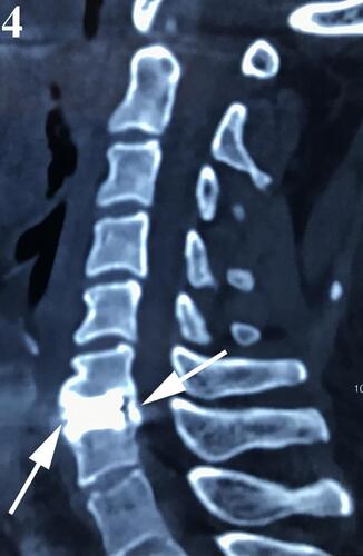 Figure 4 Computed tomography confirmed the cervical disc prosthesis was surrounded bone bridging (arrows).