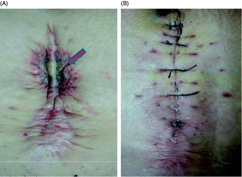 Figure 4. Pictures obtained from a 47-year-old patient with adenomyosis and abdominal scar. (A) A picture obtained immediately after HIFU shows the third degree skin burn on the surgical scar (arrow); the size of the burnt area was 1.5 × 2.0 cm (arrow). B. A picture obtained 10 days after HIFU shows the burnt skin had been resected along the abdominal scar.