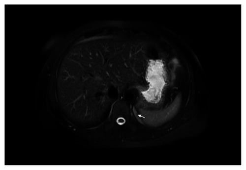 Figure 3 Magnetic resonance image of left retroperitoneal subdiaphragmatic region with mass residue (arrow).