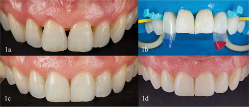 Figure 1. Clinical case 1. (a) Initial intraoral front view. (b) Detail of the isolated teeth. Anterior HD diastema closure upper mesial-distal. Bioclear matrix systems. Bioclear was used to treat the central black triangle. The specific matrices for black triangles installed on the sides (black triangle kit. Bioclear matrix systems. Bioclear) can be seen, they are color coded and the red one has a lower profile than the blue one, which allows us to close a larger area of the anterosuperior sector in which the black triangles can be seen. (c) Two weeks review. (d) Two years review, highlighting the periodontal health and restorations integrity.