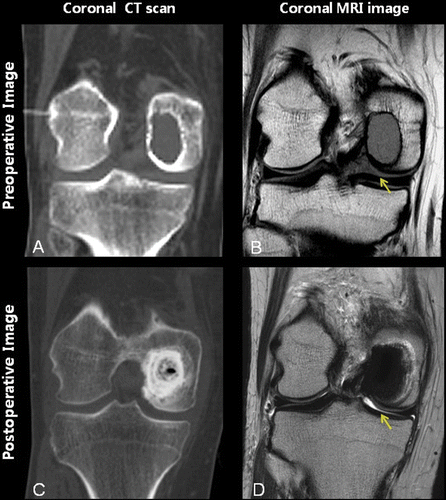 Figure 5. A 21-year-old man presented at our outpatient clinic with vague knee pain. A chondroblastoma was detected in the medial femoral condyle close to the articular cartilage on pre-operative CT and MRI coronal images (A and B). The articular cartilage (arrow) was intact on the pre-operative MRI image (B). Following navigation-guided curettage, the tumor was removed and the cavity filled with cement (C). The articular cartilage (arrow) was intact after surgery (D).