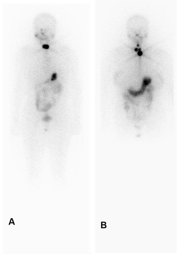 Figure 1 (A) indicates RX-WBC residual thyroid only; (B) indicates residual thyroid with lymph node metastasis.