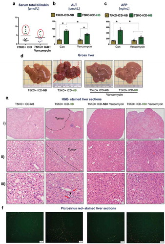 Figure 1. Vancomycin blocks inulin-induced hepatocellular carcinoma. Inulin containing diet (ICD)-fed T5KO mice were maintained either on regular drinking water or water containing vancomycin (0.5 g/L). (a) total serum bilirubin. Based on serum bilirubin levels, mice were stratified into normal bilirubin (NB) or high bilirubin (HB, denoted by green dots present in red circle) groups. (b–c) serum levels of B) alanine transaminase (ALT), an enzyme predominantly present in liver and (c) alpha-fetoprotein, a tumor marker. (d) Representative macroscopic photographs of liver. Red arrows point to HCC nodules. Histological analysis (Hematoxylin and Eosin staining) of the liver: E i–ii) Dotted line demarcates the tumor from the non-tumor containing region. (e-iii) black arrow indicates the presence of bile ducts in the tumor region, and red arrows denote mitotic figures. (f) Collagen staining by picrosirius red. Data are representative of six mice per group. Error bars indicate mean ± SEM. ANOVA, *p < .05.