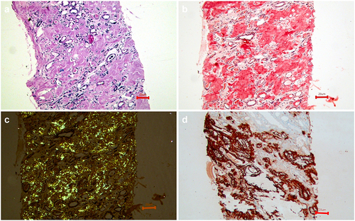 Figure 1. Low magnification view of kidney biopsy showing predominantly extra glomerular (vascular and interstitial) deposition of abundant eosinophilic material (a: H&Ex100), which is Congo red positive (b: Congo Red x100) showing apple green birefringence under cross -polarized light (c: PL x 100) and intensely positive for SAA {amyloid a associated protein} (d: IHCx100).