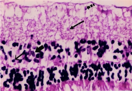 Figure 2 Placebo: Microphotograph of degeneration of retinal ganglion cells (broken arrow), edema of inner plexiform layer (long arrow), pyknotic cells in inner nuclear layer (short arrow) and polymorphonuclear leukocytes (thick arrow).