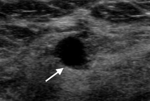 Figure 1 Gray-scale ultrasound showed a well-defined anechoic nodule (arrow) in the right breast.