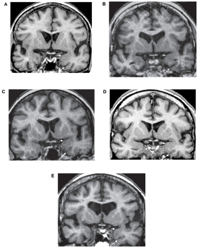Figure 2 Mesiotemporal atrophy in the vascular MR class of converters to dementia of the Alzheimer type. These oblique coronal reformatted T1-weighted images at the level of the anterior parahippocampal gyri are from five vascular type converters; one with arterial windkessel dysfunction and cerebral microangiopathy 9 months before diagnosis of dementia (A), one with arterial windkessel dysfunction and marked cortical atrophy 33 months before diagnosis of dementia (B), one with venous windkessel dysfunction 12 months before the diagnosis of dementia (C), one with resistive MR subtype 24 months before diagnosis of dementia (D), and the last one with a MR pattern of global cerebral hypoperfusion 13 months before diagnosis of dementia (E). There is no disproportionate enlargement of the left rhinal sulcus (long arrows), no marked concavity of the upper limit of the left amygdala region (short arrows), nor marked evidence of left predominance of brain atrophy.