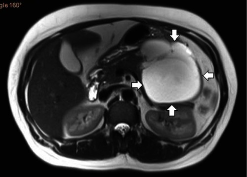 Figure 1 MRI view of the abdomen shows large multicystic mass in the body and tail of the pancreas with enhancement.
