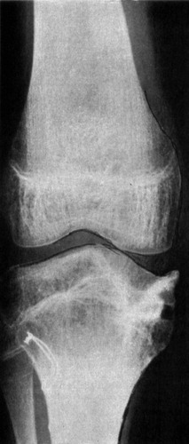 Figure 1 d. Radiograph 1 year after operative elevation of the medial tibial joint surface, showing consolidation and good correction of the varus deformity.