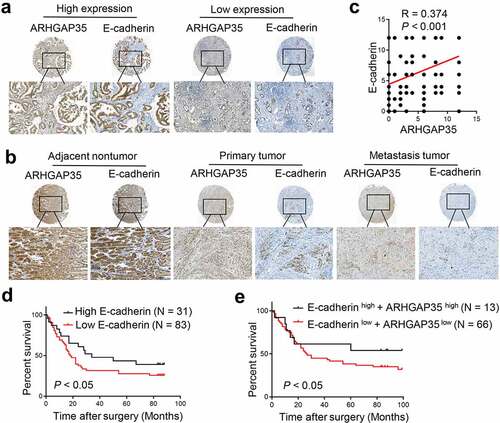 Figure 4. Simultaneous ARHGAP35 and E-cadherin downregulation is associated with poor prognosis in patients with GC. a-b-, The expression levels of ARHGAP35 and E-cadherin were determined in tissue microarrays by immunohistochemistry. c, A positive association between the expression of ARHGAP35 and E-cadherin was revealed in GC. d, E-cadherin downregulation was associated with poor prognosis in patients with GC. e, The association between ARHGAP35/E-cadherin co-expression and overall survival in patients with GC is shown. ARHGAP35, Rho GTPase‑activating protein 35; GC, gastric cancer.