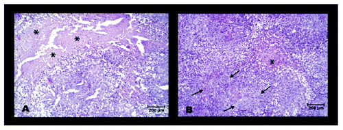 Figure 7. H&E stained slices of residual SkBr3 tumors 29 d after initiation of mock- treatment (A) or LPA treatment (B). * indicates areas of necrosis, typical for mock-treated tumors; arrows mark areas with fibrotic strings, typical for LPA treated tumors.