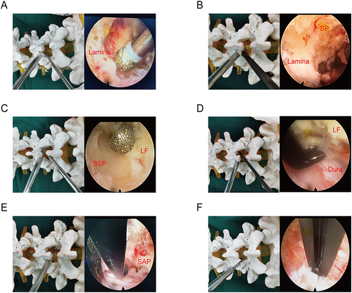 Figure 1 Schematic illustrations and endoscopic diagram of UME surgery utilized in the unilateral laminotomy for bilateral decompression. (A) Step one: High-speed grinding drill enters into the working space, and grinds off the lower edge of the cranial lamina and the inner edge of zygapophysial joints under the monitoring of spinal endoscope. The insertion point of the ligamentum flavum as shown in the right diagram. (B) Step two: The open surgical laminectomy punch, accompanied with the grinding drill, excises the lamina and the base of spinous process (SP), peels off the insertion point of the ligamentum flavum, completing the decompression of ipsilateral cranial part. (C) Step three: With the utilization of ligamentum flavum as a barrier, high-speed grinding drill remove the lamina at the base of spinous processes (BSP) and accomplish the decompression over the top, exposing the insertion point of the ligamentum flavum (LF) at the cephalic and caudal ends. (D) Step four: The ligamentum flavum is taken away with the use of nerve dissector, and the lateral edge of the dural sac is cleared by laminectomy punch. (E) Step five: For the dorsal narrow part of the contralateral nerve root canal, the superior articular process (SAP) will be polished thinner by grinding drill, and treated with endoscopic Kerrison punch under spinal endoscope safely, due to the possibility of nerve injury caused by the use of open laminectomy punch in a limited space or angle. (F) Step six: the dorsal side of the ipsilateral nerve root canal and the lateral edge of the dural sac are trimmed with endoscopic Kerrison punch, more safer and accurate compared with traditional UBE surgery.