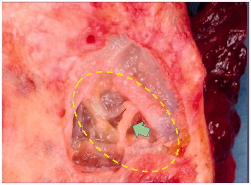 Figure 3. Blood vessel running outside the arytenoid cartilage. Care is taken to avoid damaging blood vessels outside the lateral cricoarytenoid muscle accompanying the adduction branch of the recurrent laryngeal nerve.