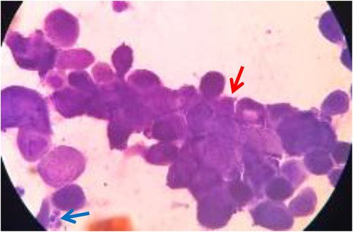 Figure 3 Tzanck smear. Appearance of MGC (Display full size) and PMN (Display full size).