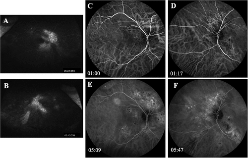 Figure 3. Fluorescein angiography and Indocyanine Green Angiography (ICG) on initial presentation of Patient 1. Fluorescein angiography revealed window defect around optic nerve and the areas of RPE atrophy, tracking inferiorly into periphery, with multifocal leakage along vascular arcades in the right eye (A) and the left eye (B). ICG showed hypocyanescence in area of PEDs seen on OCTs and hypercyanescence in peripapillary area. No polyps or choroidal neovascular membranes was observed in either eye: Early phase right eye (C) and left eye (D). Late phase right eye (E) and left eye (F).