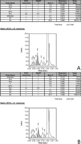 Figure 1. (A) Hb A1c measurement of the man carrying the novel variant using HPLC, not revealing the novel β-globin variant above. Below (B) HPLC evaluations of an individual not carrying any hemoglobin variants. Both evaluations were carried out using Variant II Turbo, Bio-Rad, United States.
