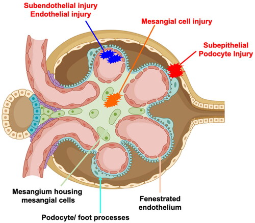 Figure 1. A simplified cross section of the glomerulus is depicted. The glomerular assembly comprises of a fenestrated endothelium (pink), which is contiguous with the mesangium that houses the mesangial cells (green). As such, mesangial cells are constantly exposed to blood components. The fenestrated endothelium is lined by the glomerular basement membrane (cyan). The other side of the basement membrane is lined by a specialised type of epithelial cells called podocytes and their foot processes (cyan with pink blebs).During the evolution of lupus nephritis (LN), circulating or in-situ formed immune complexes can deposit in the mesangial (orange, class I, II LN), sub-endothelial (blue, class III and IV) or sub-epithelial (red, class V) regions and induce cellular pathology and inflammation. Some of the common pathological features include (but are not restricted to) mesangial proliferation, basement membrane thickening, endocapillary proliferation, sclerosis, crescent formation with loss of podocyte foot processes.