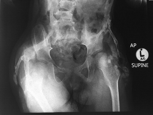 Figure 3: Radiograph showing extensive ectopic soft tissue ossification and ankylosis of the hip joints and lower lumbar spine.