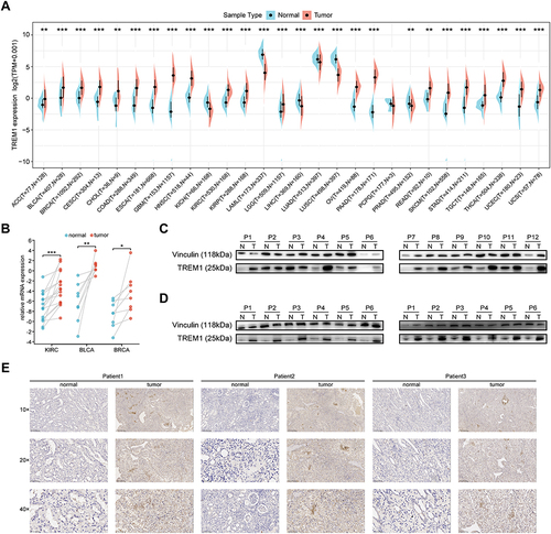 Figure 1 TREM1 expression profiles in normal tissues and tumors. (A) Expression level of TREM1 between tumor and normal tissues in pan-cancer according to the integrated data from GTEx and TCGA datasets. (B) mRNA expression of TREM1 in KIRC, BLCA and BRCA patients assessed by qRT-PCR analysis. (C) Protein expression of TREM1 detected by Western blot in paired KIRC and adjacent normal tissues. (D) Western blot protein detection of theTREM1 expression levels in paired normal tissues and BLCA (left panel), BRCA (right panel) tissues. (E) IHC of TREM1 in paired KIRC and adjacent normal tissues.