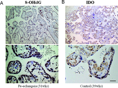 Figure 2.  Immunostaining of placental tissue cross-sections. A) Immunostaining of 8-OHdG using monoclonal antibodies (31 w gestation, pre-eclampsia, original magnification x 400; scale bar, 50 µm). The signals were detected in the nuclei of vascular endothelial cells (arrows) and syncytiotrophoblasts (arrowheads) in the chorionic villi. B) Immunostaining of IDO in a placenta (39 w gestation, normotensive pregnancy, original magnification x400; scale bar, 50 µm). Prominent staining is apparent in the cytoplasm of vascular endothelial cells (arrows) as well as syncytiotrophoblasts (arrowheads) in the chorionic villi.