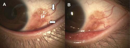 Figure 2 Slit-lamp biomicroscopic findings in Case 2. (A) Conjunctival tumor with high degree of pigmentation can be seen at the corneal limbus. There is also mild edema and feeder vessels (arrows). (B) The edema is reduced after one month of treatment with epinastine eye drops.