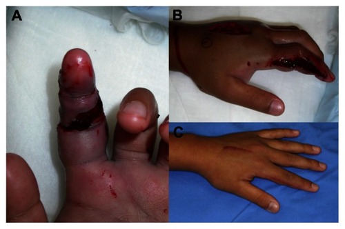 Figure 3 An 11-year-old boy was bitten by a mamushi on his left index finger (A). Relaxation incision was performed in the lateral side of the index, the dorsum of the hand, and the lateral thenar (B). He had no complaints 4 months after injury (C).