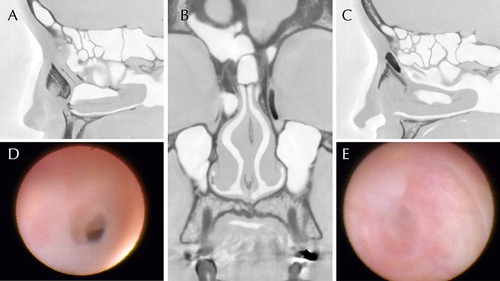 Figure 2 Consistency and discrepancy of findings between syringing and DCG+DE. DCG and diagnostic DE images of a 42-year-old female patient with a chief complaint of epiphora and discharge on her left eye lasting for 1 year. Syringing showed complete obstruction on the left and patency on the right. (A) Sagittal DCG image of the right LD. The contrast agent passed through the NLD and reached the nose. (B) Coronal DCG image showed complete obstruction at the middle of the left LD. The right LP allowed the passage of the contrast media. (C) Sagittal DCG image of the left LD. The left lacrimal sac was dilated, and the contrast media pooled at the middle of the NLD. (D) DE view of the partially obstructed site (right LP) of the same patient. NLD stenosis was observed due to inflammatory fibrous tissues. DCG+DE detected NLD partial obstruction, whereas syringing diagnosed this as a patent LP; hence, DCG+DE diverged from syringing on the right side. (E) DE view of the obstructed site (left LP). Membranous inflammatory complete obstruction was observed in the middle part of the NLD. Thus, DCG+DE was consistent with syringing on the left side. The original DCG images were converted to monochrome to facilitate the observation of the contrast media.