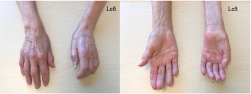 Figure 1 Left hand presenting with trophic changes of skin.