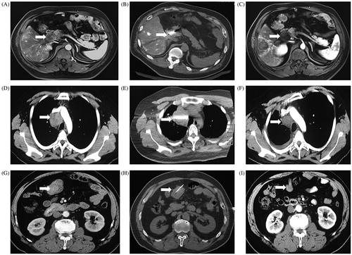 Figure 1. Ablation therapies for lymph node metastases originating from hepatocellular carcinoma. (A) The preoperative MR imaging showed a porta hepatic LN metastasis. (B) The microwave antenna was advanced into the target lesion. (C) The MR imaging at 5 days later showed partial response and mild heterogenous enhancement. (D) The preoperative computed tomography scan showed a superior vena caval LN metastasis. (E) The radiofrequency electrode was advanced into the lesion. (F) The CT scan 6 months later showed complete response and no enhancement. (G) The preoperative computed tomography scan showed a retroperitoneal LN metastasis. (H) Absolute alcohol (20ml) was slowly injected into the retroperitoneal LN metastasis. (I) The CT scan 3 months later showed significant tumor shrinkage, complete response and no enhancement.