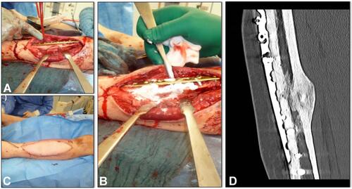 Figure 1 Implant coating of a plate; (A) tibial defect after stabilization with a LCP; (B) Augmentation of the tibial defect and the plate; (C) after closing the defect with a ALT-flap; (D) bone healing in CT-scan 15 month later.