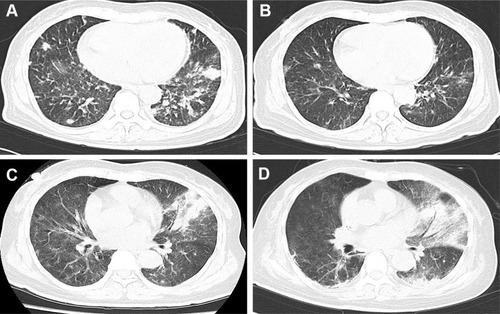 Figure 2 Computed tomography (CT) manifestation of recurrent pulmonary infection. The recurrent pneumonia was observed during the hospitalization (A), and could be relieved by multiple antibiotic treatments (B). (C) showed exacerbation of infection before the detection of mycobacterium kansasii (with air bronchogram and pulmonary consolidation), and the situation did not get improved after multiple treatments (D).