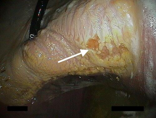Figure 6 Ulcer (white arrow). Notice the characteristic depressed center surrounded by a prominent margin of tissue. Image property of the author.