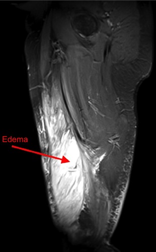 Figure 4 Sagittal STIR image demonstrating the extent of right vastus medialis edema (red arrow).