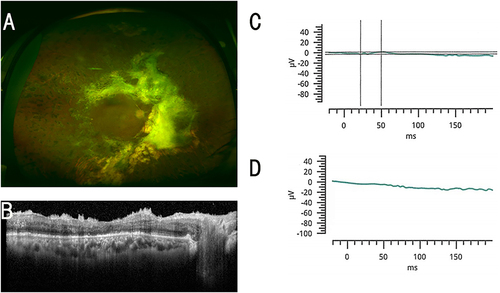 Figure 2 Representative ERGs of a 49-year-old man whose ERG was flat in the SO filled eye. (A) Fundus photograph of the right eye after the SO removal. (B) OCT image of the right eye after the SO removal. (C) Combined rod-cone responses before the SO removal. (D) Combined rod-cone responses after the SO removal. The decimal visual acuity improved from 0.2 to 0.4 (from 0.70 to 0.40 logarithm of the minimum angle of resolution; logMAR units) after the SO removal.